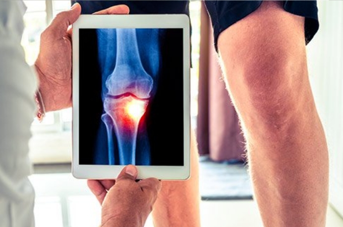 Osteoarthritis